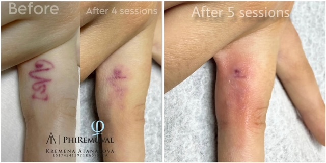 PhiRemoval — резултат
